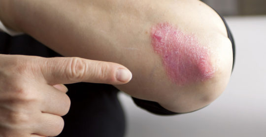 Che cos’è la psoriasi e il suo trattamento alle Terme di Cervia