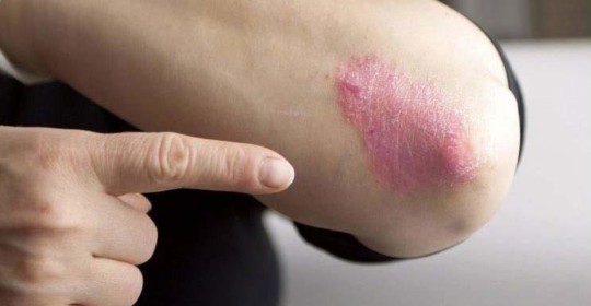 Fanghi Liman e acqua madre alleati preziosi contro la psoriasi