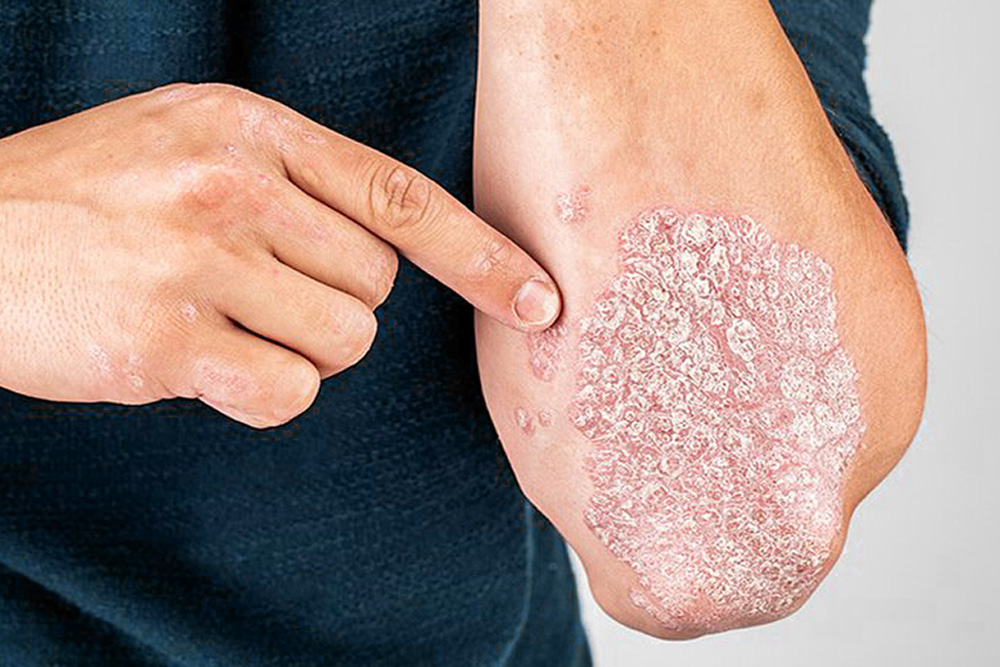 Che cosa è la psoriasi?