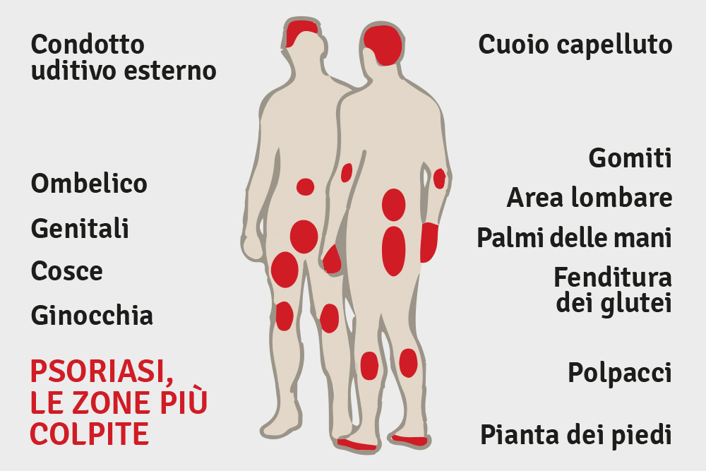 Psoriasi, le zone più colpite